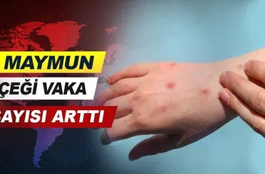 Maymun çiçeği vaka sayısında son durum belli oldu